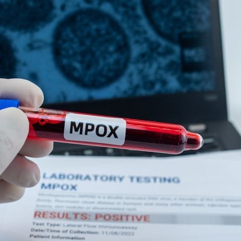 Τι είναι η Mpox, πώς μεταδίδεται και πώς αντιμετωπίζεται-Οι συστάσεις των ειδικών