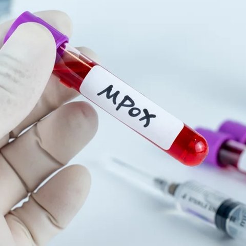 Παγκόσμια ανησυχία για τον Mpox-Προειδοποιούν για σοβαρές συνέπειες αν δεν αντιμετωπιστεί οι ειδικοί