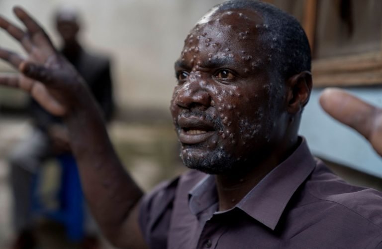 2024-07-24T083716Z_743285404_RC2EW8ANCTVB_RTRMADP_5_HEALTH-MPOX-CONGO-768x500